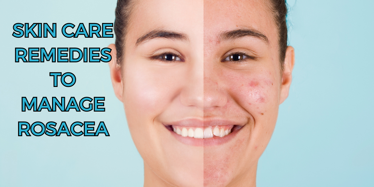 skin care remedies to manage rosacea