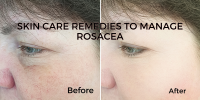 skin care remedies to manage rosacea